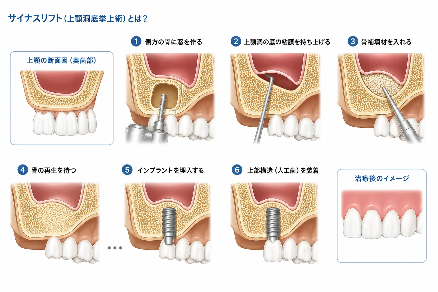 サイナスリフト（上顎洞底挙上術）の治療手順イメージ