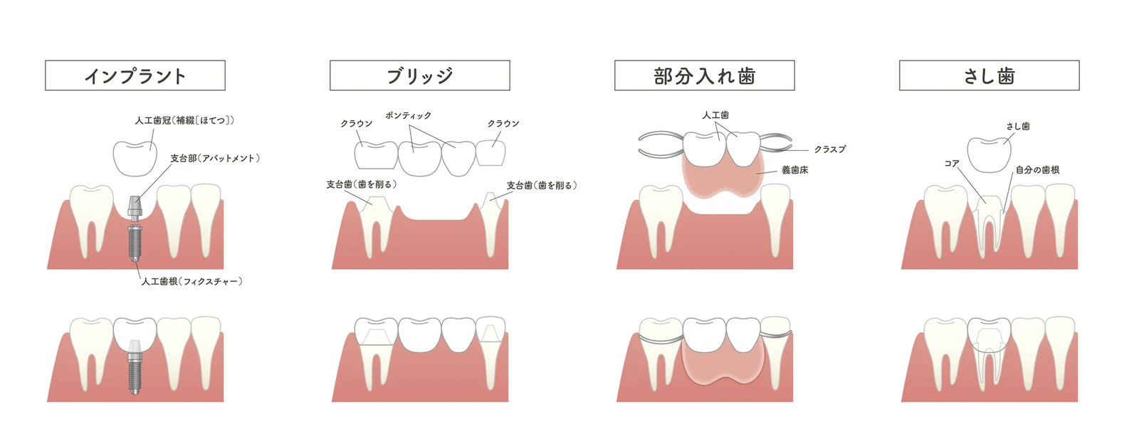 インプラント・ブリッジ・部分入れ歯・さし歯の構造比較図