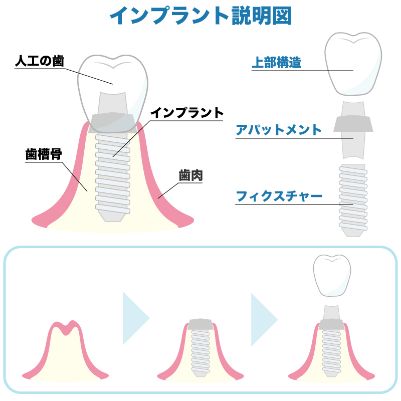 インプラント体・アバットメント・人工歯の構造図